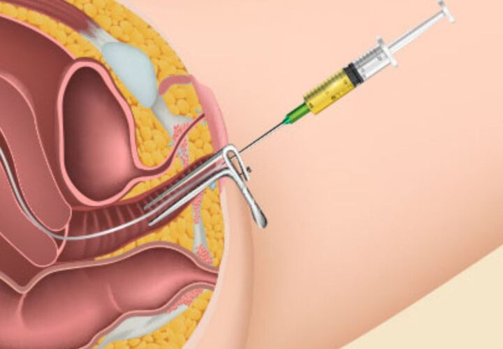 Hysteroscopy Treatment